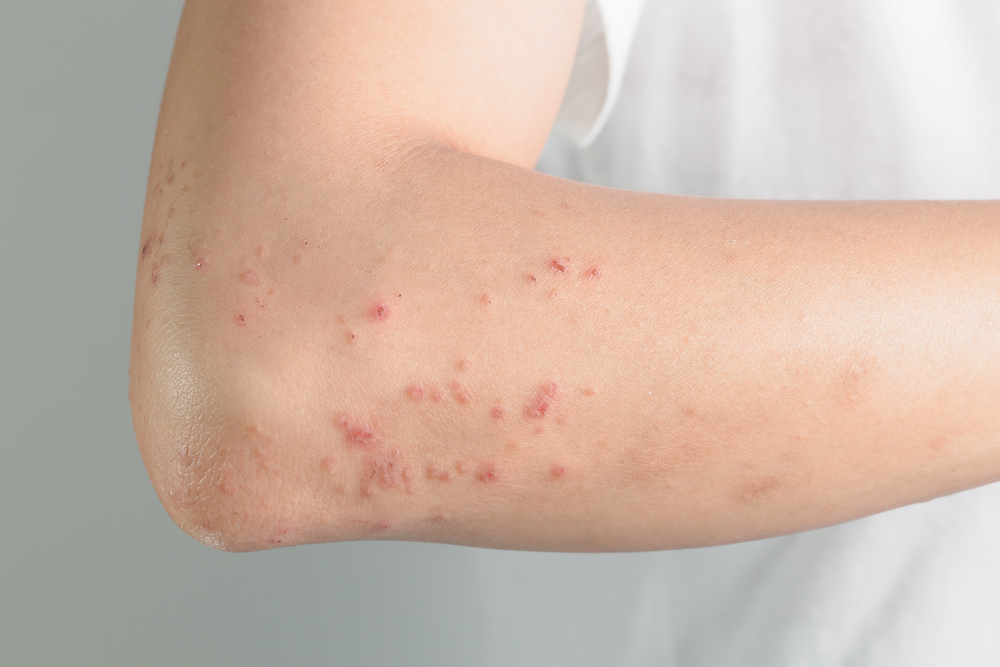 Shingles Vaccine Associated With Lower Risk For Long-Term Pain Among Patients