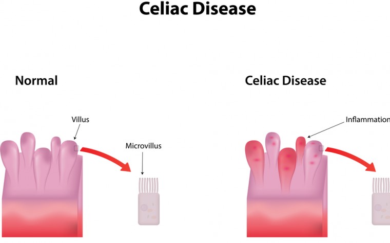 celiac disease and FM
