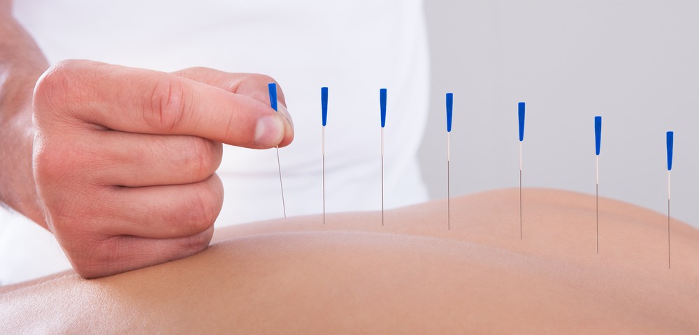 Fibromyalgia Pain May Be Eased by Personalized Acupuncture