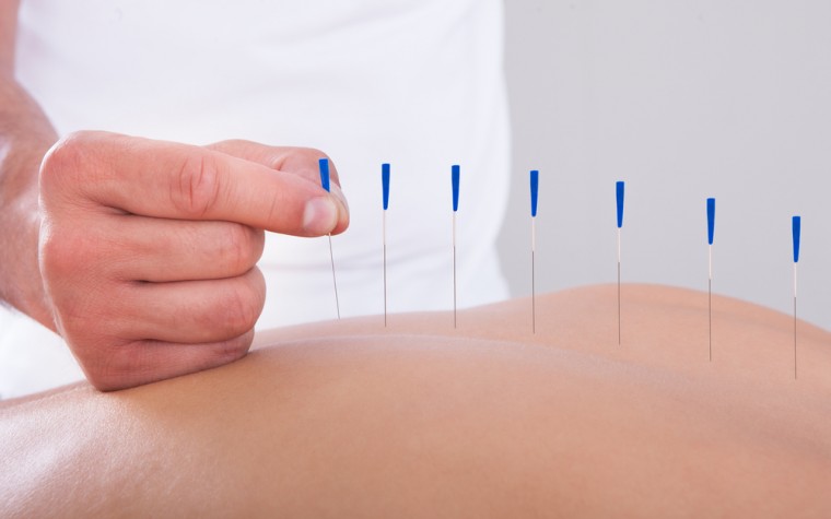 fibromyalgia and accupuncture
