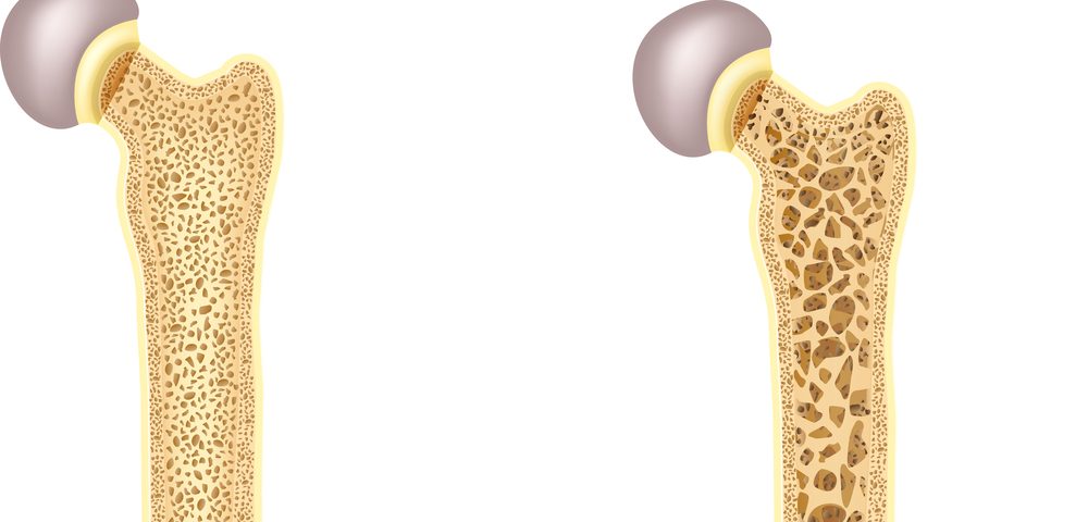 Fibromyalgia Patients May Be at Risk of Developing Osteoporosis, Study Suggests