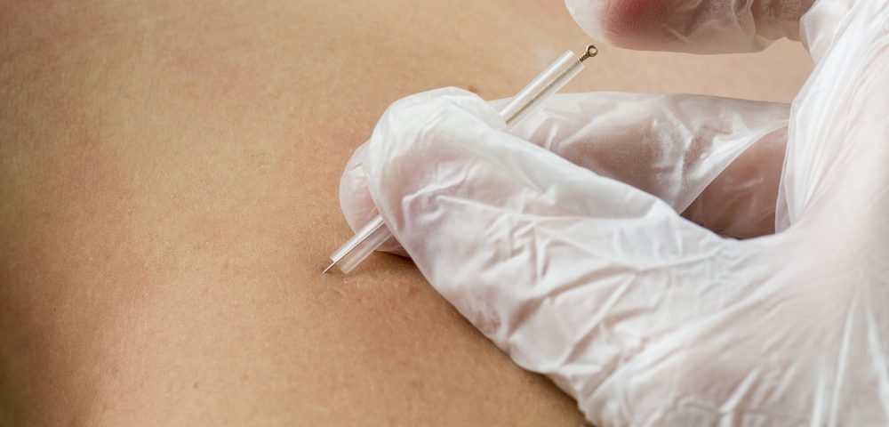 Dry Needling Improves Spinal Mobility, Reduces Pain in Fibromyalgia, Study Finds