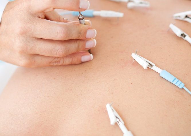 Mapping effects of electroacupuncture