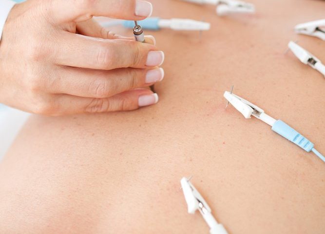 Mapping Effects of Electroacupuncture Paves Way for Targeted Fibromyalgia Pain Treatments