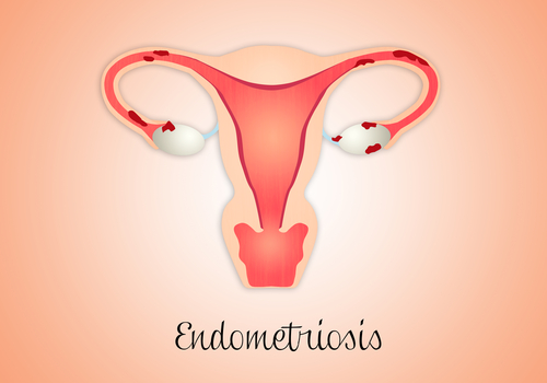 endometriosis prevalence